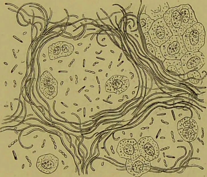 An illustration from Clinical diagnosis : the bacteriological, chemical, and microscopical evidence of disease / By Dr. Rudolf v. Jaksch, ... Translated from the third German edition and enlarged by James Cagney, ... With numerous illustrations (partly in colours)., 1893, leaf 125
