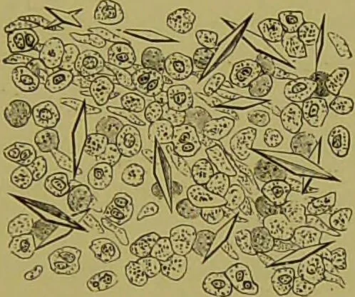 An illustration from Clinical diagnosis : the bacteriological, chemical, and microscopical evidence of disease / By Dr. Rudolf v. Jaksch, ... Translated from the third German edition and enlarged by James Cagney, ... With numerous illustrations (partly in colours)., 1893, leaf 139