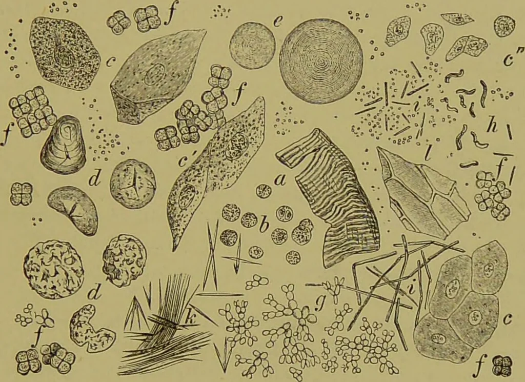An illustration from Clinical diagnosis : the bacteriological, chemical, and microscopical evidence of disease / By Dr. Rudolf v. Jaksch, ... Translated from the third German edition and enlarged by James Cagney, ... With numerous illustrations (partly in colours)., 1893, leaf 173