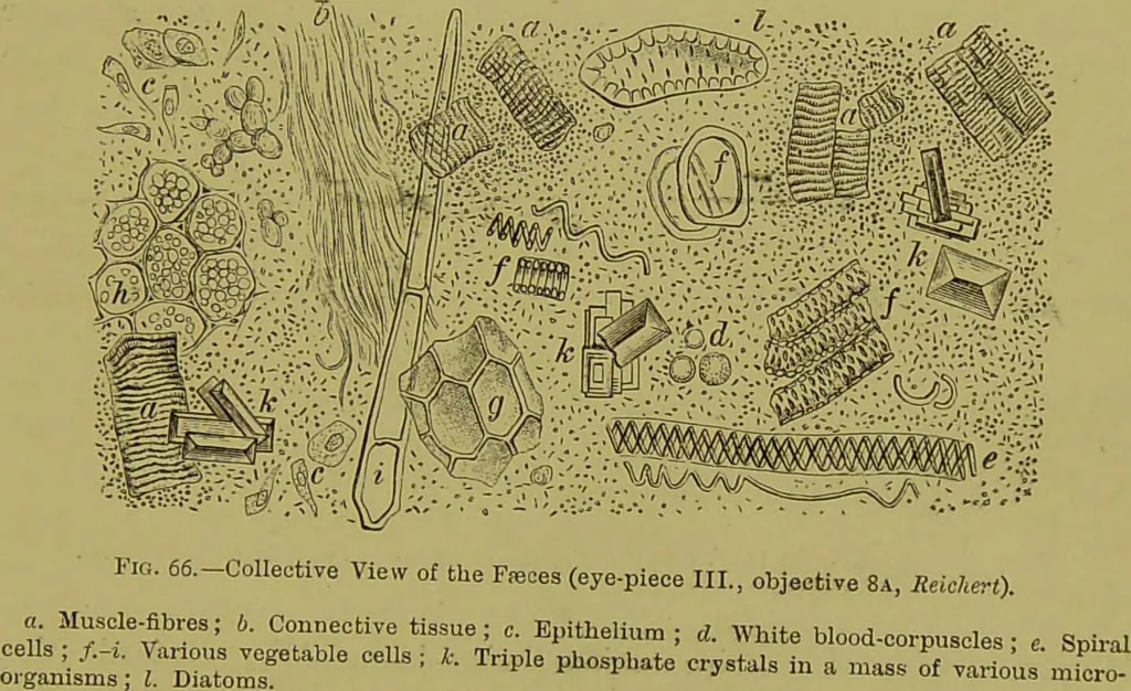 An illustration from Clinical diagnosis : the bacteriological, chemical, and microscopical evidence of disease / By Dr. Rudolf v. Jaksch, ... Translated from the third German edition and enlarged by James Cagney, ... With numerous illustrations (partly in colours)., 1893, leaf 195