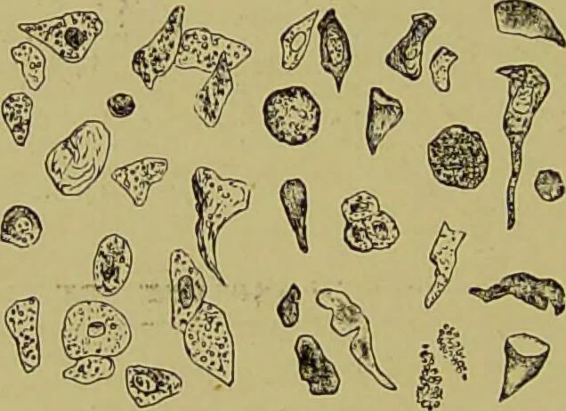An illustration from Clinical diagnosis : the bacteriological, chemical, and microscopical evidence of disease / By Dr. Rudolf v. Jaksch, ... Translated from the third German edition and enlarged by James Cagney, ... With numerous illustrations (partly in colours)., 1893, leaf 196