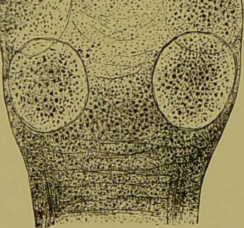 An illustration from Clinical diagnosis : the bacteriological, chemical, and microscopical evidence of disease / By Dr. Rudolf v. Jaksch, ... Translated from the third German edition and enlarged by James Cagney, ... With numerous illustrations (partly in colours)., 1893, leaf 211