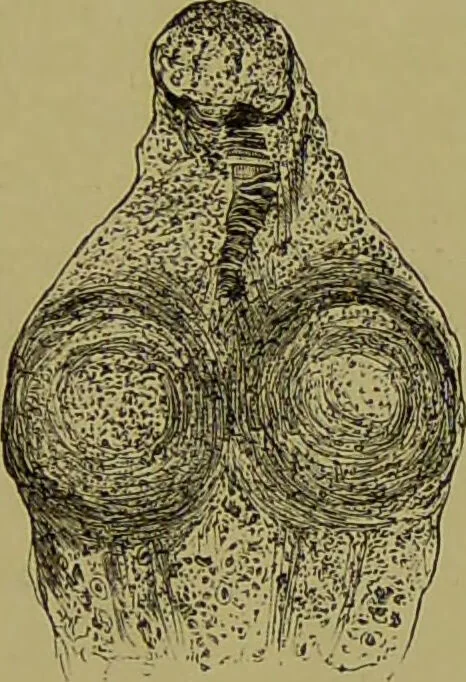 An illustration from Clinical diagnosis : the bacteriological, chemical, and microscopical evidence of disease / By Dr. Rudolf v. Jaksch, ... Translated from the third German edition and enlarged by James Cagney, ... With numerous illustrations (partly in colours)., 1893, leaf 213