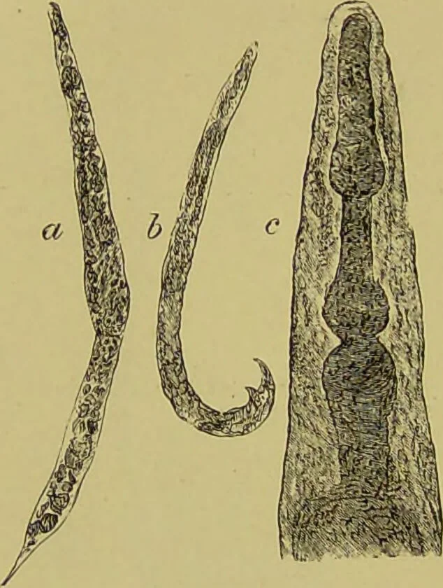 An illustration from Clinical diagnosis : the bacteriological, chemical, and microscopical evidence of disease / By Dr. Rudolf v. Jaksch, ... Translated from the third German edition and enlarged by James Cagney, ... With numerous illustrations (partly in colours)., 1893, leaf 222