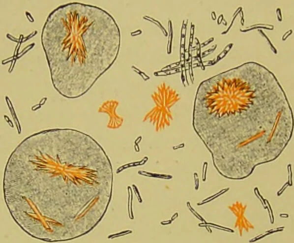 An illustration from Clinical diagnosis : the bacteriological, chemical, and microscopical evidence of disease / By Dr. Rudolf v. Jaksch, ... Translated from the third German edition and enlarged by James Cagney, ... With numerous illustrations (partly in colours)., 1893, leaf 224