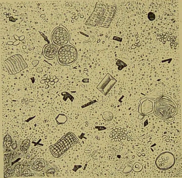 An illustration from Clinical diagnosis : the bacteriological, chemical, and microscopical evidence of disease / By Dr. Rudolf v. Jaksch, ... Translated from the third German edition and enlarged by James Cagney, ... With numerous illustrations (partly in colours)., 1893, leaf 226