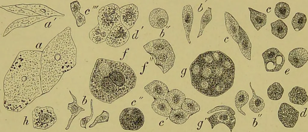 An illustration from Clinical diagnosis : the bacteriological, chemical, and microscopical evidence of disease / By Dr. Rudolf v. Jaksch, ... Translated from the third German edition and enlarged by James Cagney, ... With numerous illustrations (partly in colours)., 1893, leaf 250