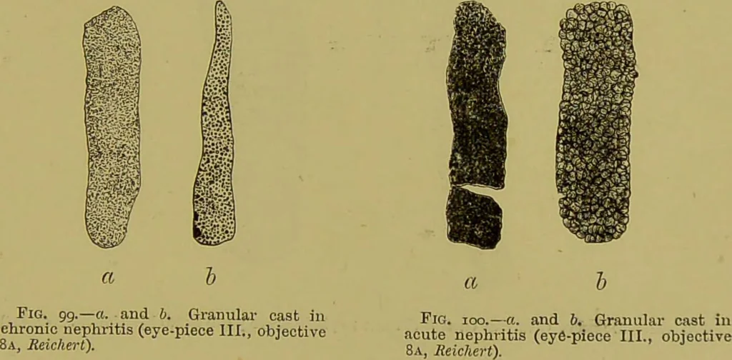 An illustration from Clinical diagnosis : the bacteriological, chemical, and microscopical evidence of disease / By Dr. Rudolf v. Jaksch, ... Translated from the third German edition and enlarged by James Cagney, ... With numerous illustrations (partly in colours)., 1893, leaf 255