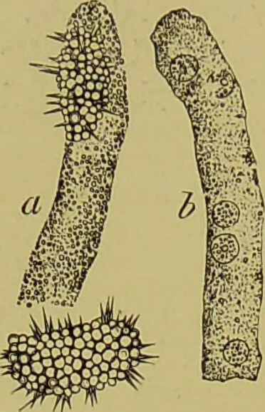 An illustration from Clinical diagnosis : the bacteriological, chemical, and microscopical evidence of disease / By Dr. Rudolf v. Jaksch, ... Translated from the third German edition and enlarged by James Cagney, ... With numerous illustrations (partly in colours)., 1893, leaf 258