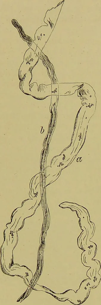 An illustration from Clinical diagnosis : the bacteriological, chemical, and microscopical evidence of disease / By Dr. Rudolf v. Jaksch, ... Translated from the third German edition and enlarged by James Cagney, ... With numerous illustrations (partly in colours)., 1893, leaf 260