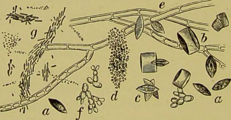 An illustration from Clinical diagnosis : the bacteriological, chemical, and microscopical evidence of disease / By Dr. Rudolf v. Jaksch, ... Translated from the third German edition and enlarged by James Cagney, ... With numerous illustrations (partly in colours)., 1893, leaf 262