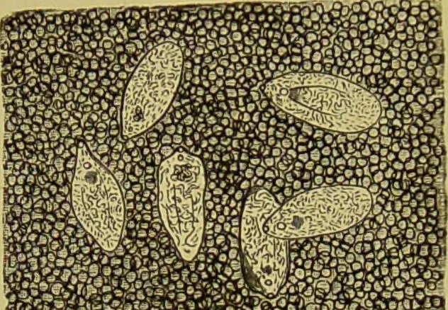 An illustration from Clinical diagnosis : the bacteriological, chemical, and microscopical evidence of disease / By Dr. Rudolf v. Jaksch, ... Translated from the third German edition and enlarged by James Cagney, ... With numerous illustrations (partly in colours)., 1893, leaf 266