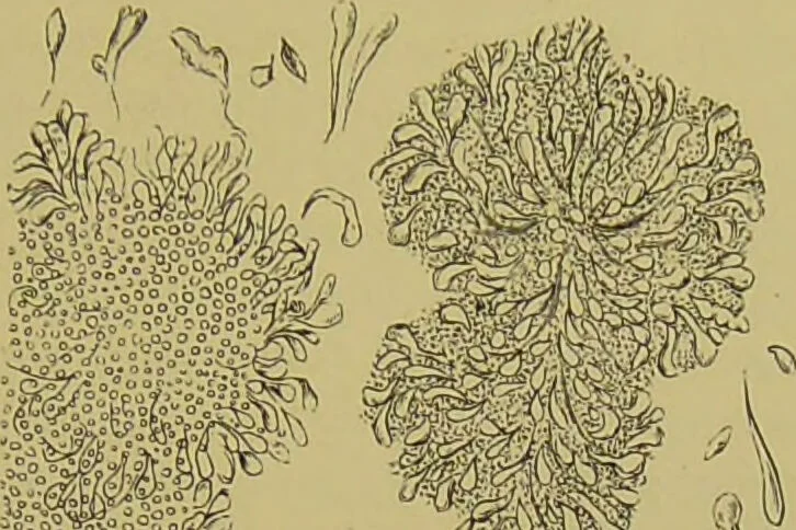 An illustration from Clinical diagnosis : the bacteriological, chemical, and microscopical evidence of disease / By Dr. Rudolf v. Jaksch, ... Translated from the third German edition and enlarged by James Cagney, ... With numerous illustrations (partly in colours)., 1893, leaf 379