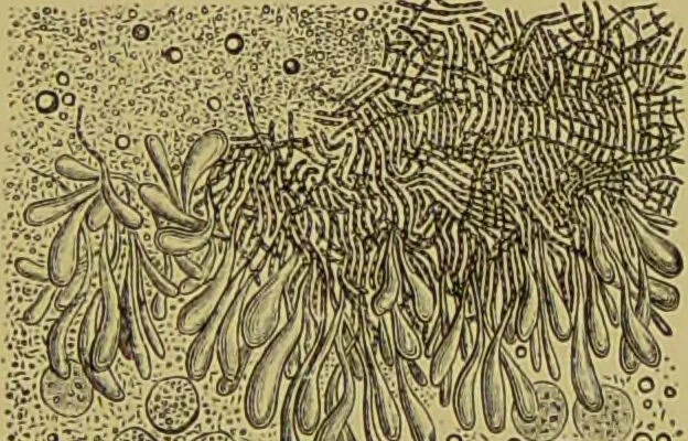 An illustration from Clinical diagnosis : the bacteriological, chemical, and microscopical evidence of disease / By Dr. Rudolf v. Jaksch, ... Translated from the third German edition and enlarged by James Cagney, ... With numerous illustrations (partly in colours)., 1893, leaf 379