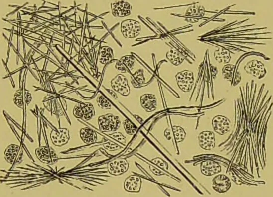 An illustration from Clinical diagnosis : the bacteriological, chemical, and microscopical evidence of disease / By Dr. Rudolf v. Jaksch, ... Translated from the third German edition and enlarged by James Cagney, ... With numerous illustrations (partly in colours)., 1893, leaf 387