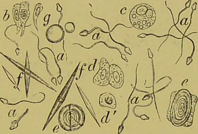 An illustration from Clinical diagnosis : the bacteriological, chemical, and microscopical evidence of disease / By Dr. Rudolf v. Jaksch, ... Translated from the third German edition and enlarged by James Cagney, ... With numerous illustrations (partly in colours)., 1893, leaf 395