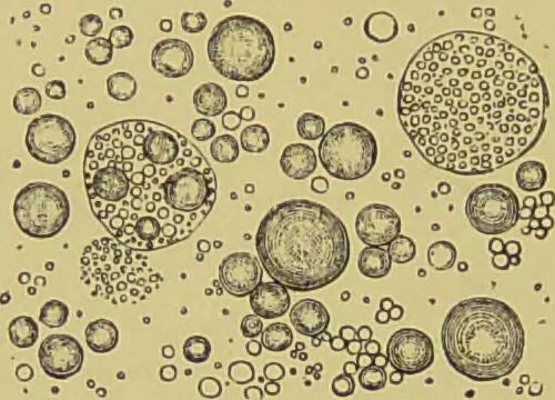 An illustration from Clinical diagnosis : the bacteriological, chemical, and microscopical evidence of disease / By Dr. Rudolf v. Jaksch, ... Translated from the third German edition and enlarged by James Cagney, ... With numerous illustrations (partly in colours)., 1893, leaf 396