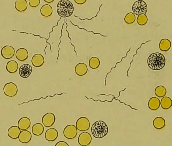 An illustration from Clinical diagnosis : the bacteriological, chemical, and microscopical evidence of disease / By Dr. Rudolf v. Jaksch, ... Translated from the third German edition and enlarged by James Cagney, ... With numerous illustrations (partly in colours)., 1893, leaf 72