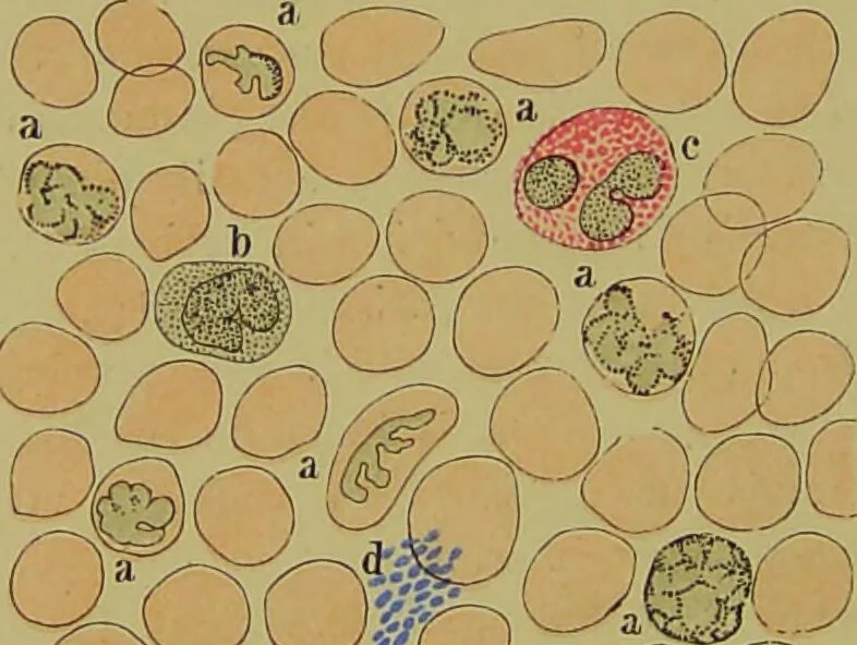 An illustration from Clinical diagnosis : the bacteriological, chemical, and microscopical evidence of disease / By Dr. Rudolf v. Jaksch, ... Translated from the third German edition and enlarged by James Cagney, ... With numerous illustrations (partly in colours)., 1893, leaf 84