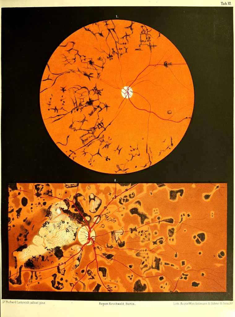 An illustration from Atlas of ophthalmoscopy : Representing the normal and pathological conditions of the fundus oculi as seen with the ophthalmoscope. Composed of 12 chromolithographic plates, containing 59 figures, drawn from nature and accompanied by an explanatory text / by Dr. R. Liebreich, the text translated by H. Rosborough Swanzy., 1870, leaf 57