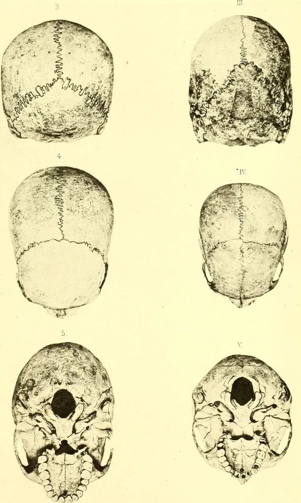 An illustration from Des déformations artificielles du crâne en général de celles de deux crânes macrocéphales trouvés en Hongrie et d'un crâne provenant des temps barbares du meme pays / par Joseph de Lenhossék., 1878, leaf 155