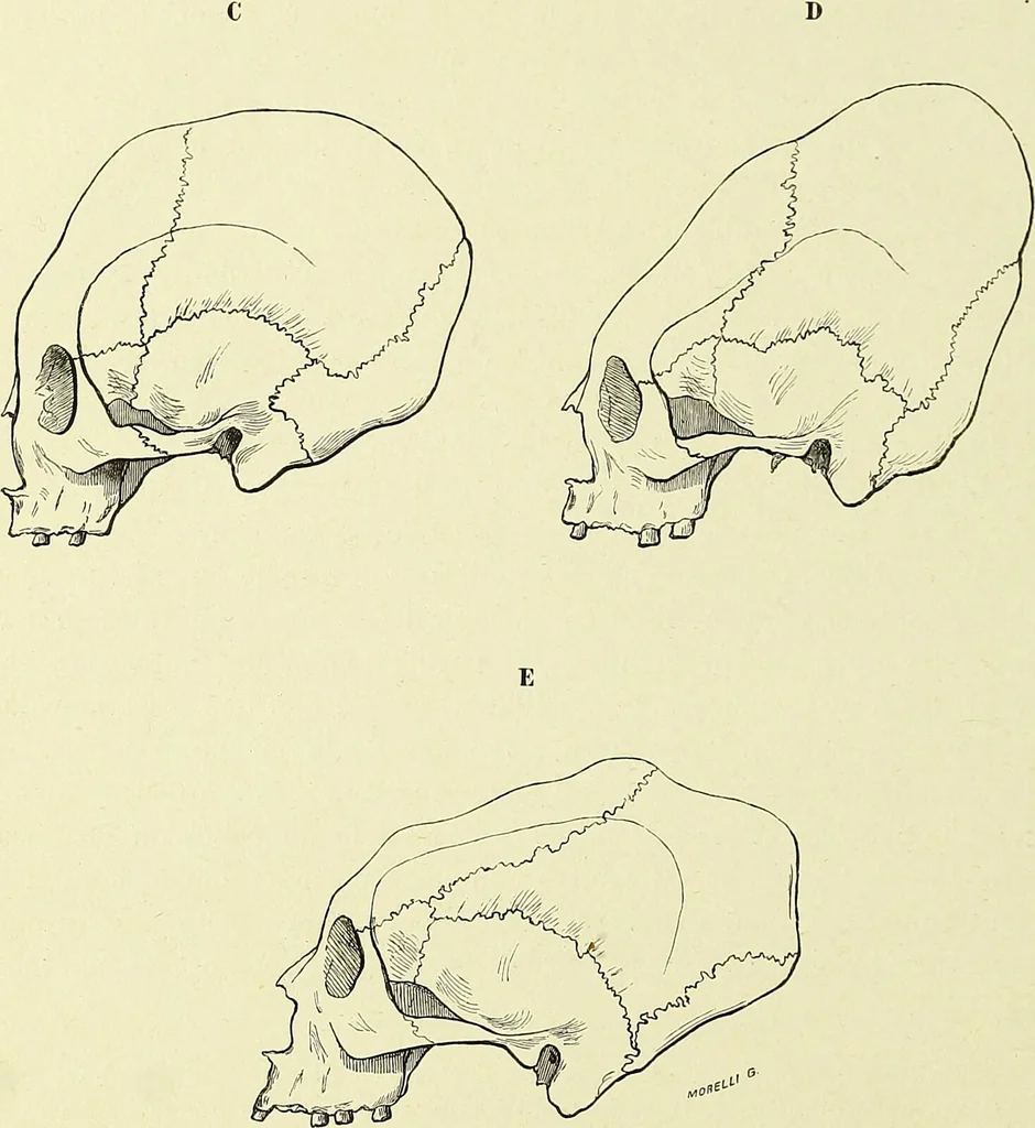 An illustration from Des déformations artificielles du crâne en général de celles de deux crânes macrocéphales trouvés en Hongrie et d'un crâne provenant des temps barbares du meme pays / par Joseph de Lenhossék., 1878, leaf 42