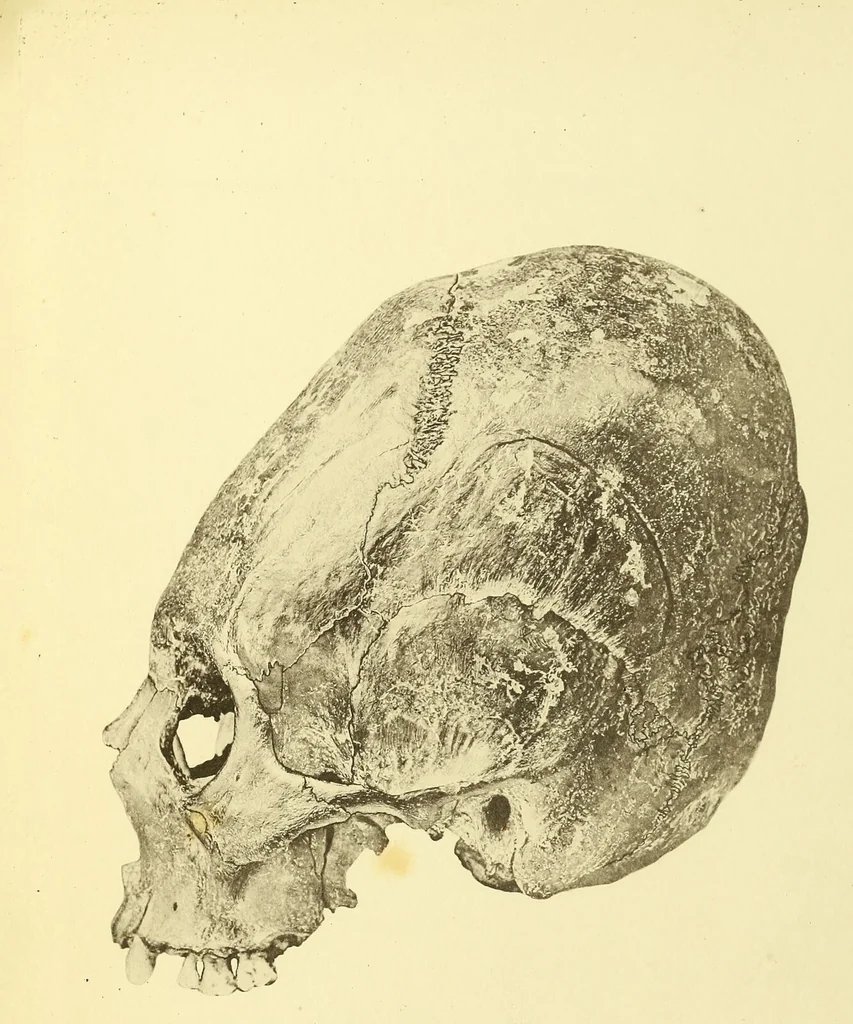 An illustration from Des déformations artificielles du crâne en général de celles de deux crânes macrocéphales trouvés en Hongrie et d'un crâne provenant des temps barbares du meme pays / par Joseph de Lenhossék., 1878, leaf 6
