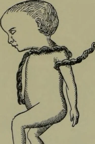 An illustration from Anomalies and curiosities of medicine : being an encyclopedic collection of rare and extraordinary cases, and of the most striking instances of abnormality in all branches of medicine and surgery, derived from an exhaustive research of medical literature from its origin to the present day / abstracted, classified, annotated, and indexed, by George M. Gould and Walter L. Pyle ; with 295 illustrations in the text, and 12 half-tone and colored plates., 1897, leaf 104
