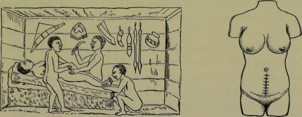 An illustration from Anomalies and curiosities of medicine : being an encyclopedic collection of rare and extraordinary cases, and of the most striking instances of abnormality in all branches of medicine and surgery, derived from an exhaustive research of medical literature from its origin to the present day / abstracted, classified, annotated, and indexed, by George M. Gould and Walter L. Pyle ; with 295 illustrations in the text, and 12 half-tone and colored plates., 1897, leaf 139