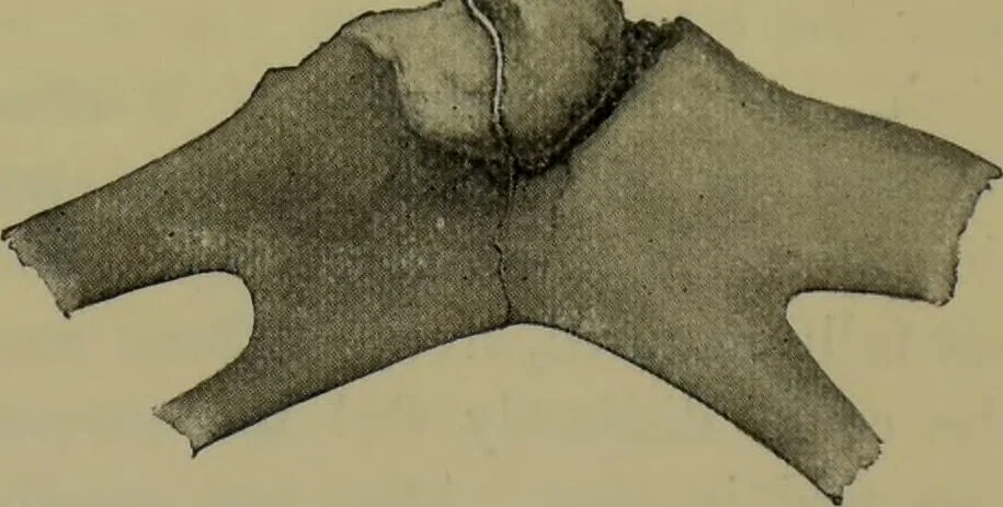 An illustration from Anomalies and curiosities of medicine : being an encyclopedic collection of rare and extraordinary cases, and of the most striking instances of abnormality in all branches of medicine and surgery, derived from an exhaustive research of medical literature from its origin to the present day / abstracted, classified, annotated, and indexed, by George M. Gould and Walter L. Pyle ; with 295 illustrations in the text, and 12 half-tone and colored plates., 1897, leaf 149