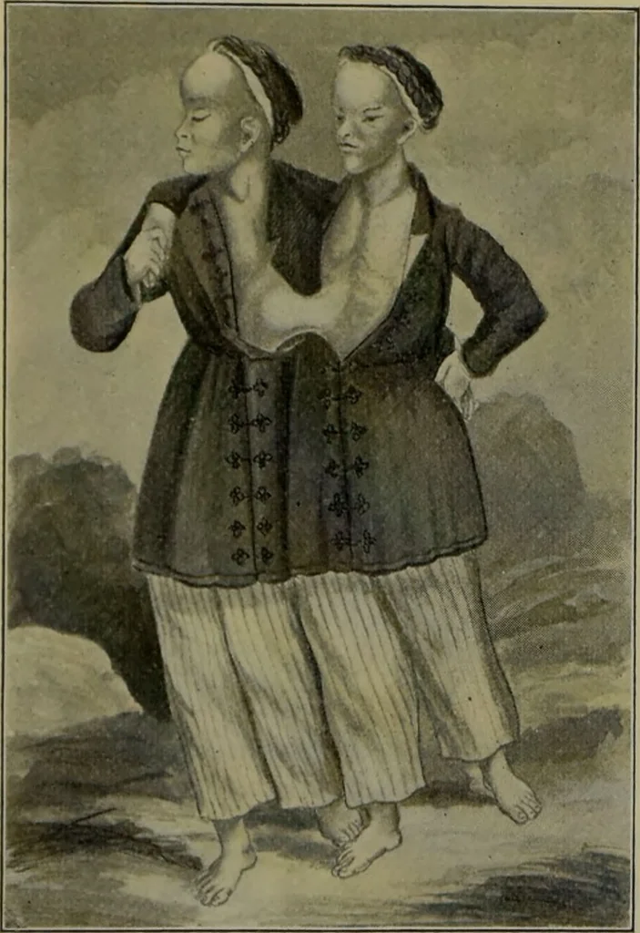 An illustration from Anomalies and curiosities of medicine : being an encyclopedic collection of rare and extraordinary cases, and of the most striking instances of abnormality in all branches of medicine and surgery, derived from an exhaustive research of medical literature from its origin to the present day / abstracted, classified, annotated, and indexed, by George M. Gould and Walter L. Pyle ; with 295 illustrations in the text, and 12 half-tone and colored plates., 1897, leaf 174