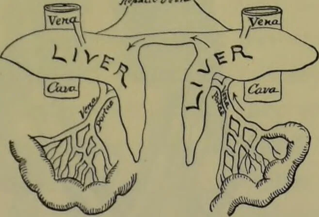 An illustration from Anomalies and curiosities of medicine : being an encyclopedic collection of rare and extraordinary cases, and of the most striking instances of abnormality in all branches of medicine and surgery, derived from an exhaustive research of medical literature from its origin to the present day / abstracted, classified, annotated, and indexed, by George M. Gould and Walter L. Pyle ; with 295 illustrations in the text, and 12 half-tone and colored plates., 1897, leaf 177
