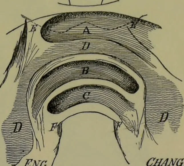 An illustration from Anomalies and curiosities of medicine : being an encyclopedic collection of rare and extraordinary cases, and of the most striking instances of abnormality in all branches of medicine and surgery, derived from an exhaustive research of medical literature from its origin to the present day / abstracted, classified, annotated, and indexed, by George M. Gould and Walter L. Pyle ; with 295 illustrations in the text, and 12 half-tone and colored plates., 1897, leaf 177