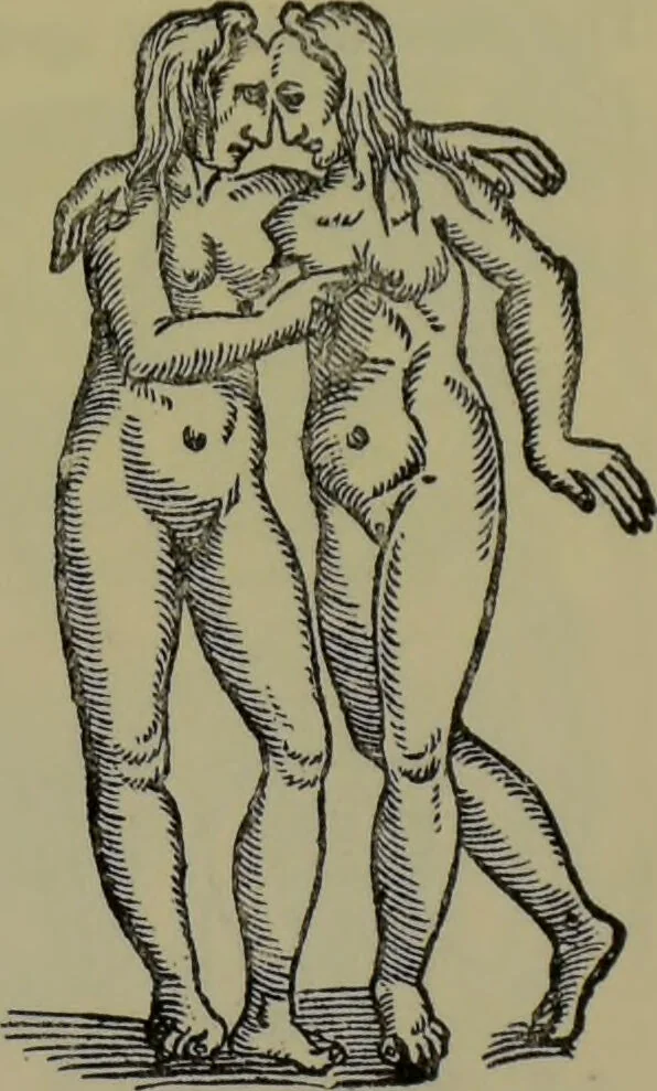 An illustration from Anomalies and curiosities of medicine : being an encyclopedic collection of rare and extraordinary cases, and of the most striking instances of abnormality in all branches of medicine and surgery, derived from an exhaustive research of medical literature from its origin to the present day / abstracted, classified, annotated, and indexed, by George M. Gould and Walter L. Pyle ; with 295 illustrations in the text, and 12 half-tone and colored plates., 1897, leaf 179
