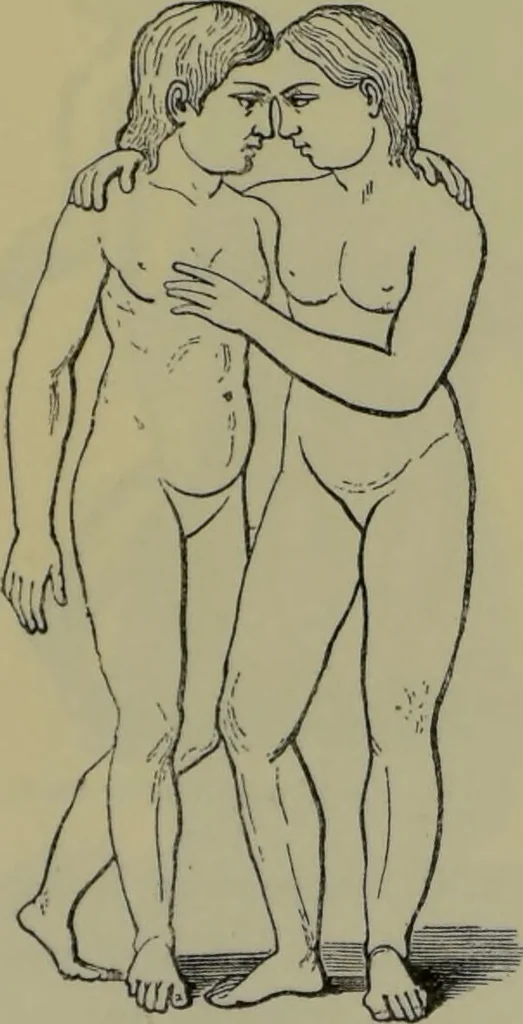 An illustration from Anomalies and curiosities of medicine : being an encyclopedic collection of rare and extraordinary cases, and of the most striking instances of abnormality in all branches of medicine and surgery, derived from an exhaustive research of medical literature from its origin to the present day / abstracted, classified, annotated, and indexed, by George M. Gould and Walter L. Pyle ; with 295 illustrations in the text, and 12 half-tone and colored plates., 1897, leaf 180