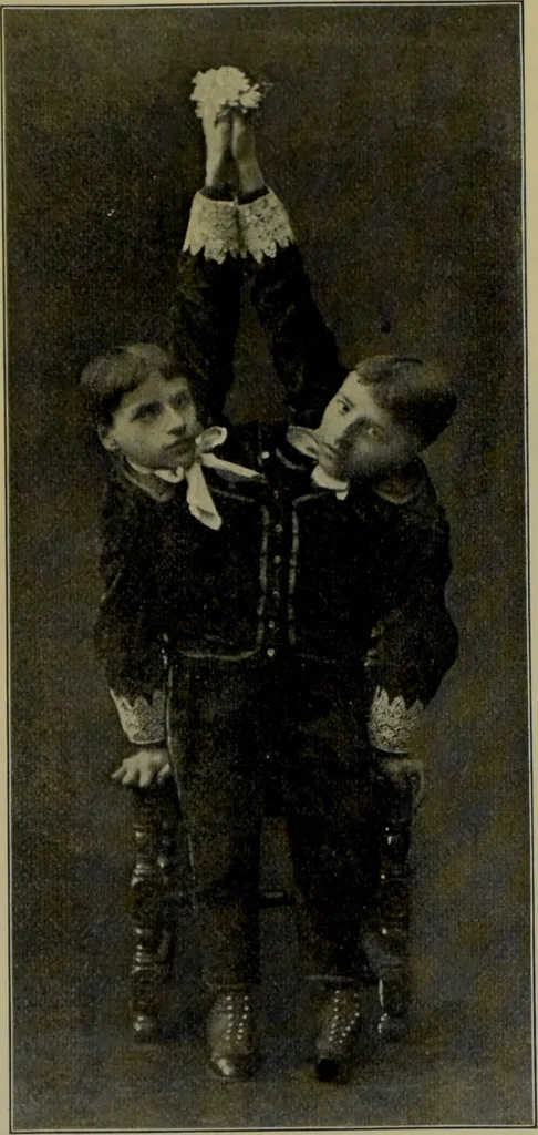 An illustration from Anomalies and curiosities of medicine : being an encyclopedic collection of rare and extraordinary cases, and of the most striking instances of abnormality in all branches of medicine and surgery, derived from an exhaustive research of medical literature from its origin to the present day / abstracted, classified, annotated, and indexed, by George M. Gould and Walter L. Pyle ; with 295 illustrations in the text, and 12 half-tone and colored plates., 1897, leaf 192