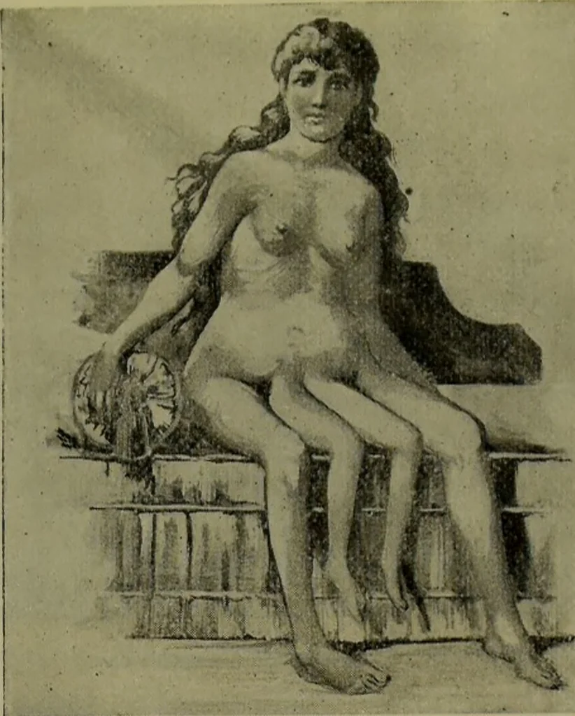An illustration from Anomalies and curiosities of medicine : being an encyclopedic collection of rare and extraordinary cases, and of the most striking instances of abnormality in all branches of medicine and surgery, derived from an exhaustive research of medical literature from its origin to the present day / abstracted, classified, annotated, and indexed, by George M. Gould and Walter L. Pyle ; with 295 illustrations in the text, and 12 half-tone and colored plates., 1897, leaf 201