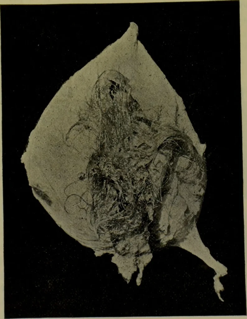 An illustration from Anomalies and curiosities of medicine : being an encyclopedic collection of rare and extraordinary cases, and of the most striking instances of abnormality in all branches of medicine and surgery, derived from an exhaustive research of medical literature from its origin to the present day / abstracted, classified, annotated, and indexed, by George M. Gould and Walter L. Pyle ; with 295 illustrations in the text, and 12 half-tone and colored plates., 1897, leaf 211