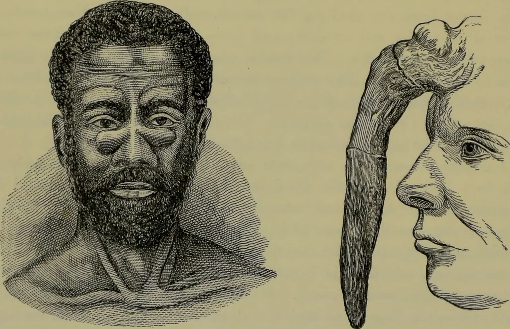 An illustration from Anomalies and curiosities of medicine : being an encyclopedic collection of rare and extraordinary cases, and of the most striking instances of abnormality in all branches of medicine and surgery, derived from an exhaustive research of medical literature from its origin to the present day / abstracted, classified, annotated, and indexed, by George M. Gould and Walter L. Pyle ; with 295 illustrations in the text, and 12 half-tone and colored plates., 1897, leaf 234