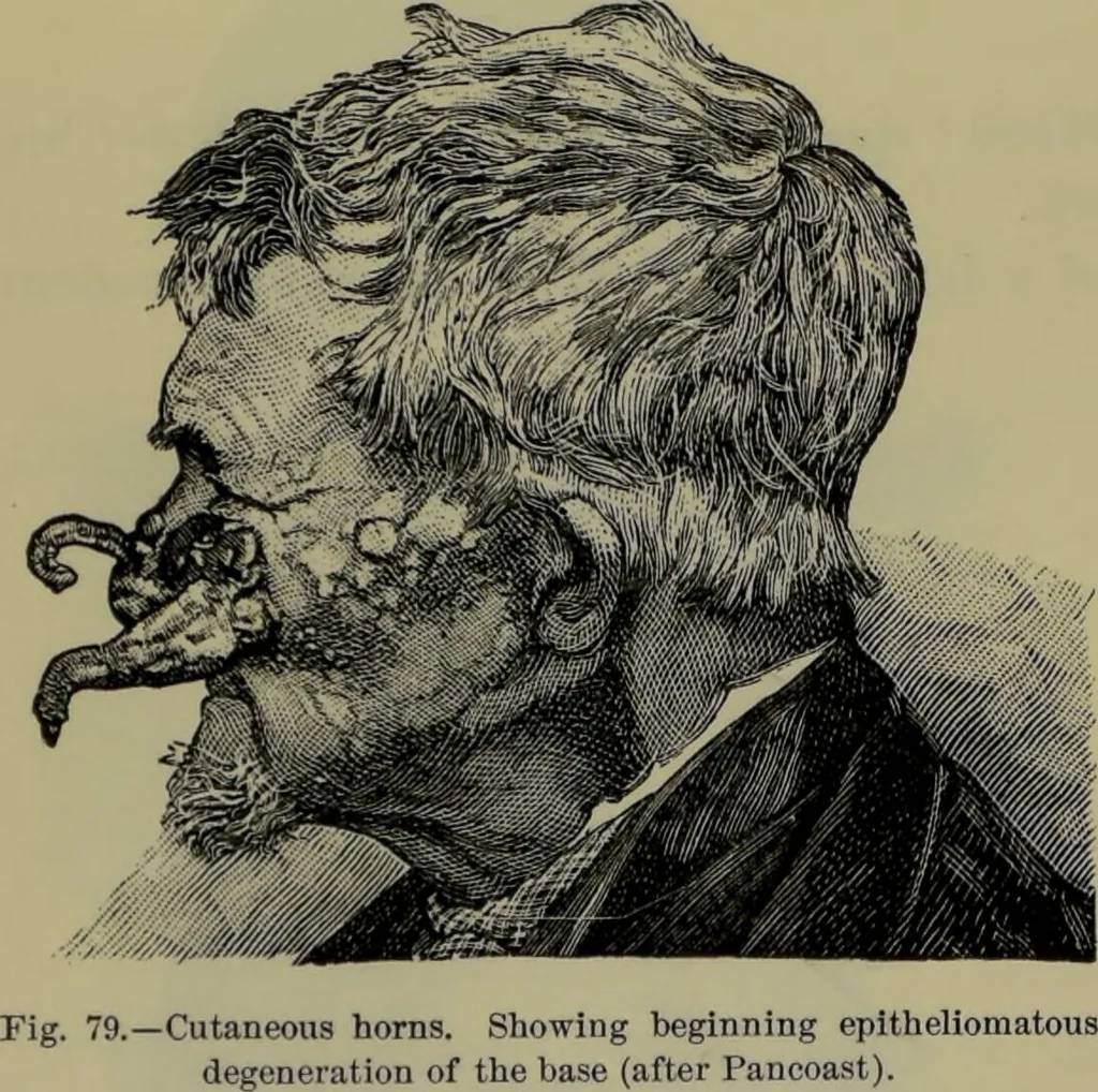 An illustration from Anomalies and curiosities of medicine : being an encyclopedic collection of rare and extraordinary cases, and of the most striking instances of abnormality in all branches of medicine and surgery, derived from an exhaustive research of medical literature from its origin to the present day / abstracted, classified, annotated, and indexed, by George M. Gould and Walter L. Pyle ; with 295 illustrations in the text, and 12 half-tone and colored plates., 1897, leaf 236