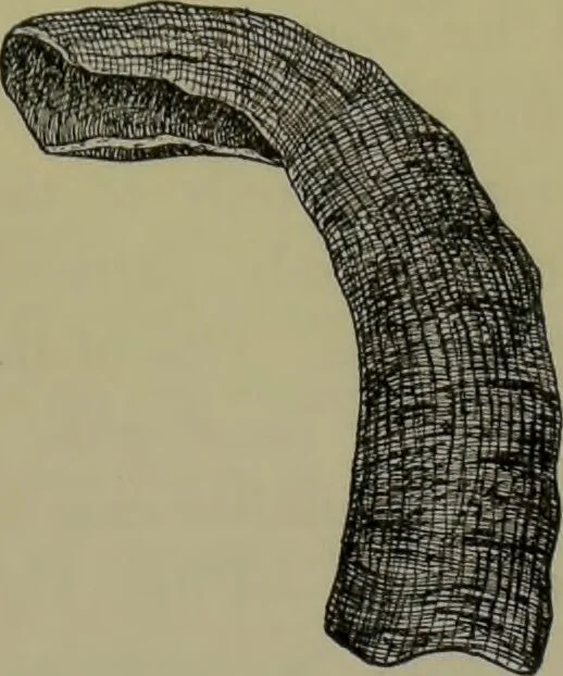 An illustration from Anomalies and curiosities of medicine : being an encyclopedic collection of rare and extraordinary cases, and of the most striking instances of abnormality in all branches of medicine and surgery, derived from an exhaustive research of medical literature from its origin to the present day / abstracted, classified, annotated, and indexed, by George M. Gould and Walter L. Pyle ; with 295 illustrations in the text, and 12 half-tone and colored plates., 1897, leaf 251