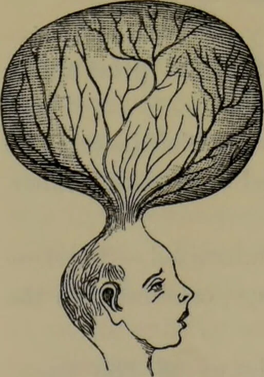 An illustration from Anomalies and curiosities of medicine : being an encyclopedic collection of rare and extraordinary cases, and of the most striking instances of abnormality in all branches of medicine and surgery, derived from an exhaustive research of medical literature from its origin to the present day / abstracted, classified, annotated, and indexed, by George M. Gould and Walter L. Pyle ; with 295 illustrations in the text, and 12 half-tone and colored plates., 1897, leaf 261