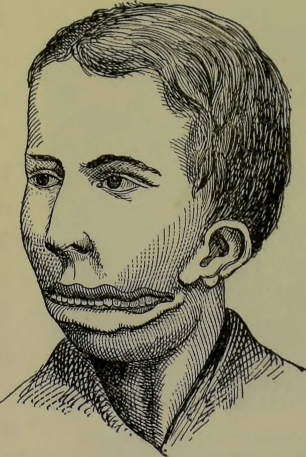 An illustration from Anomalies and curiosities of medicine : being an encyclopedic collection of rare and extraordinary cases, and of the most striking instances of abnormality in all branches of medicine and surgery, derived from an exhaustive research of medical literature from its origin to the present day / abstracted, classified, annotated, and indexed, by George M. Gould and Walter L. Pyle ; with 295 illustrations in the text, and 12 half-tone and colored plates., 1897, leaf 263