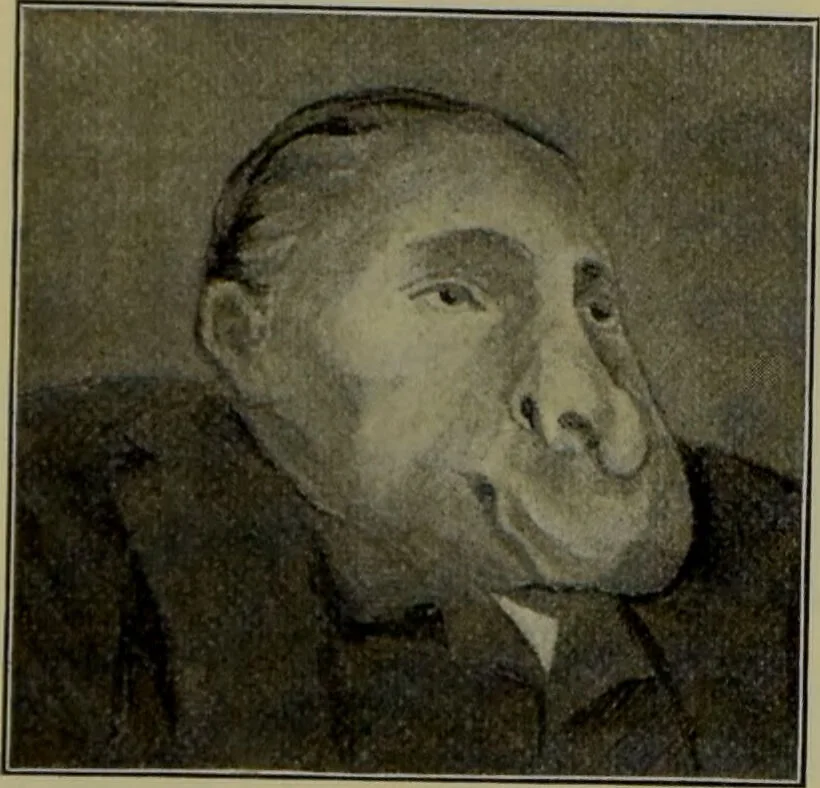 An illustration from Anomalies and curiosities of medicine : being an encyclopedic collection of rare and extraordinary cases, and of the most striking instances of abnormality in all branches of medicine and surgery, derived from an exhaustive research of medical literature from its origin to the present day / abstracted, classified, annotated, and indexed, by George M. Gould and Walter L. Pyle ; with 295 illustrations in the text, and 12 half-tone and colored plates., 1897, leaf 264