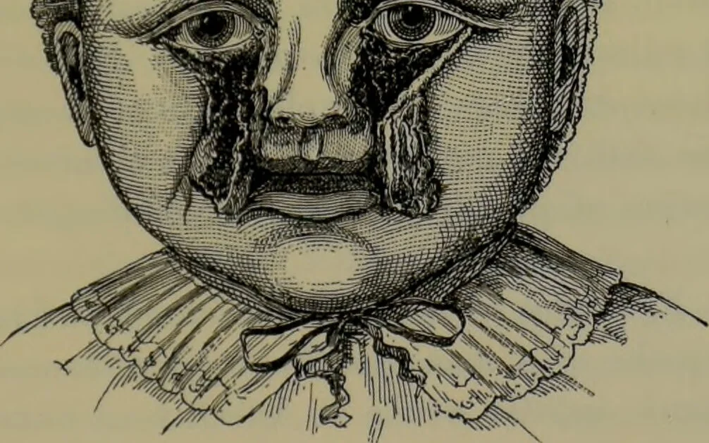 An illustration from Anomalies and curiosities of medicine : being an encyclopedic collection of rare and extraordinary cases, and of the most striking instances of abnormality in all branches of medicine and surgery, derived from an exhaustive research of medical literature from its origin to the present day / abstracted, classified, annotated, and indexed, by George M. Gould and Walter L. Pyle ; with 295 illustrations in the text, and 12 half-tone and colored plates., 1897, leaf 265