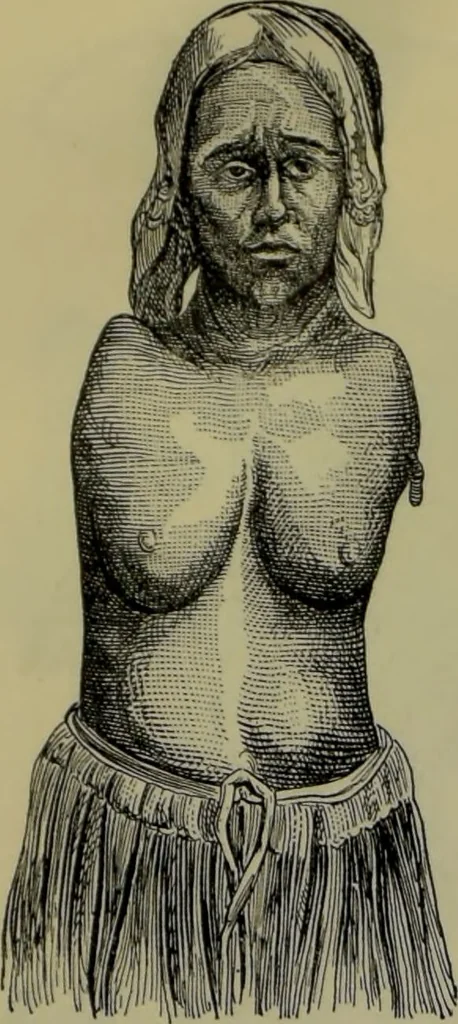 An illustration from Anomalies and curiosities of medicine : being an encyclopedic collection of rare and extraordinary cases, and of the most striking instances of abnormality in all branches of medicine and surgery, derived from an exhaustive research of medical literature from its origin to the present day / abstracted, classified, annotated, and indexed, by George M. Gould and Walter L. Pyle ; with 295 illustrations in the text, and 12 half-tone and colored plates., 1897, leaf 276