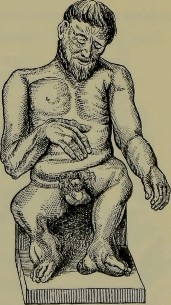 An illustration from Anomalies and curiosities of medicine : being an encyclopedic collection of rare and extraordinary cases, and of the most striking instances of abnormality in all branches of medicine and surgery, derived from an exhaustive research of medical literature from its origin to the present day / abstracted, classified, annotated, and indexed, by George M. Gould and Walter L. Pyle ; with 295 illustrations in the text, and 12 half-tone and colored plates., 1897, leaf 276