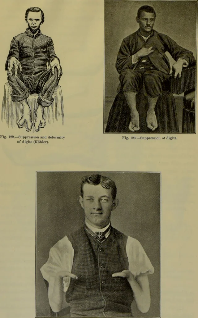 An illustration from Anomalies and curiosities of medicine : being an encyclopedic collection of rare and extraordinary cases, and of the most striking instances of abnormality in all branches of medicine and surgery, derived from an exhaustive research of medical literature from its origin to the present day / abstracted, classified, annotated, and indexed, by George M. Gould and Walter L. Pyle ; with 295 illustrations in the text, and 12 half-tone and colored plates., 1897, leaf 282