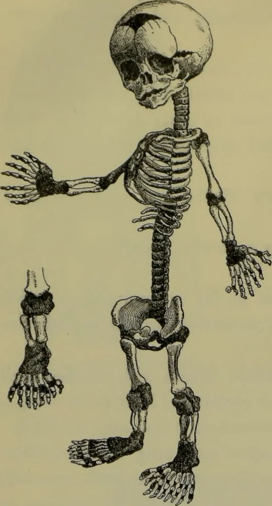 An illustration from Anomalies and curiosities of medicine : being an encyclopedic collection of rare and extraordinary cases, and of the most striking instances of abnormality in all branches of medicine and surgery, derived from an exhaustive research of medical literature from its origin to the present day / abstracted, classified, annotated, and indexed, by George M. Gould and Walter L. Pyle ; with 295 illustrations in the text, and 12 half-tone and colored plates., 1897, leaf 284