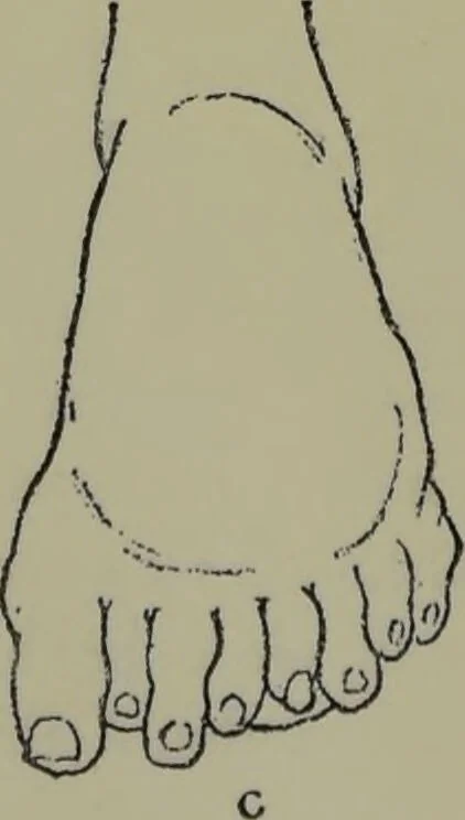 An illustration from Anomalies and curiosities of medicine : being an encyclopedic collection of rare and extraordinary cases, and of the most striking instances of abnormality in all branches of medicine and surgery, derived from an exhaustive research of medical literature from its origin to the present day / abstracted, classified, annotated, and indexed, by George M. Gould and Walter L. Pyle ; with 295 illustrations in the text, and 12 half-tone and colored plates., 1897, leaf 284